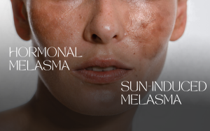 Distinguishing types of melasma